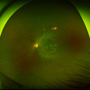 広角眼底写真撮影（最周辺部）