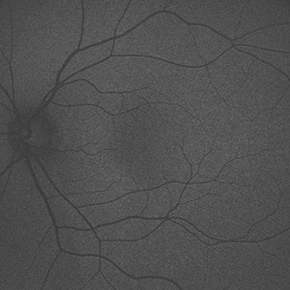 自発蛍光眼底写真