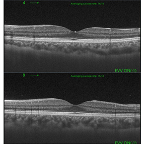 眼底光干渉断層系（後眼部OCT）