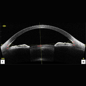 前眼部光干渉断層計（前眼部OCT）