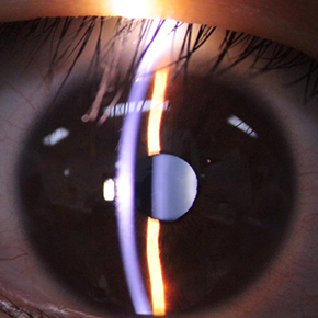 細隙灯顕微鏡による観察