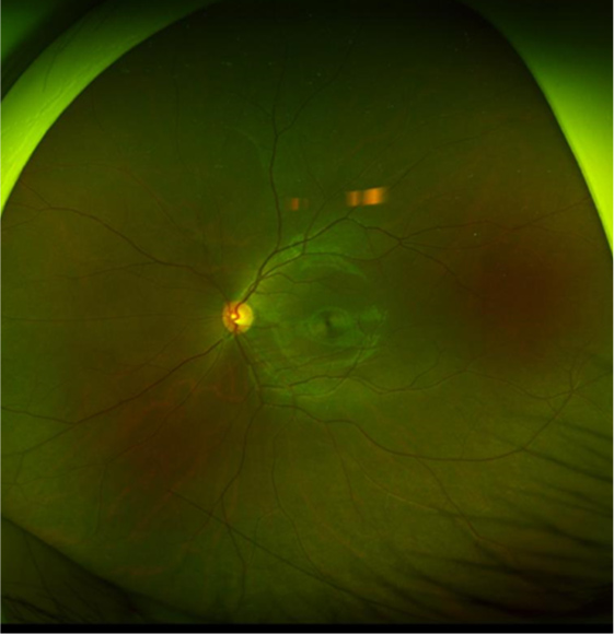 広角眼底写真撮影（最周辺部）
