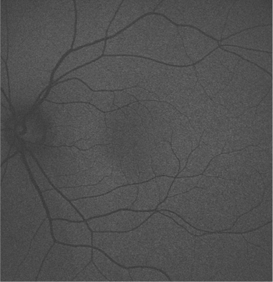 自発蛍光眼底写真