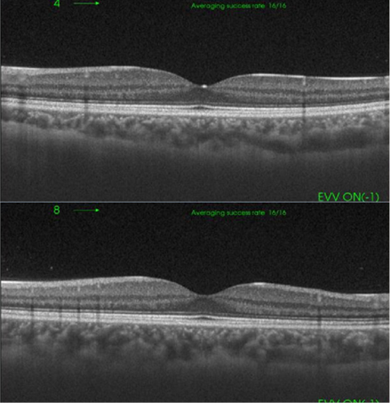 眼底光干渉断層系（後眼部OCT）