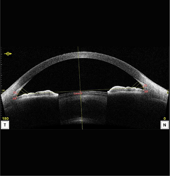 前眼部光干渉断層計（前眼部OCT）