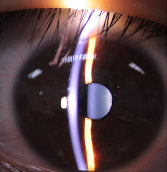 細隙灯顕微鏡による観察