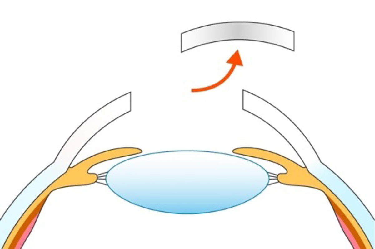 中央の角膜の全層を円状に切除する