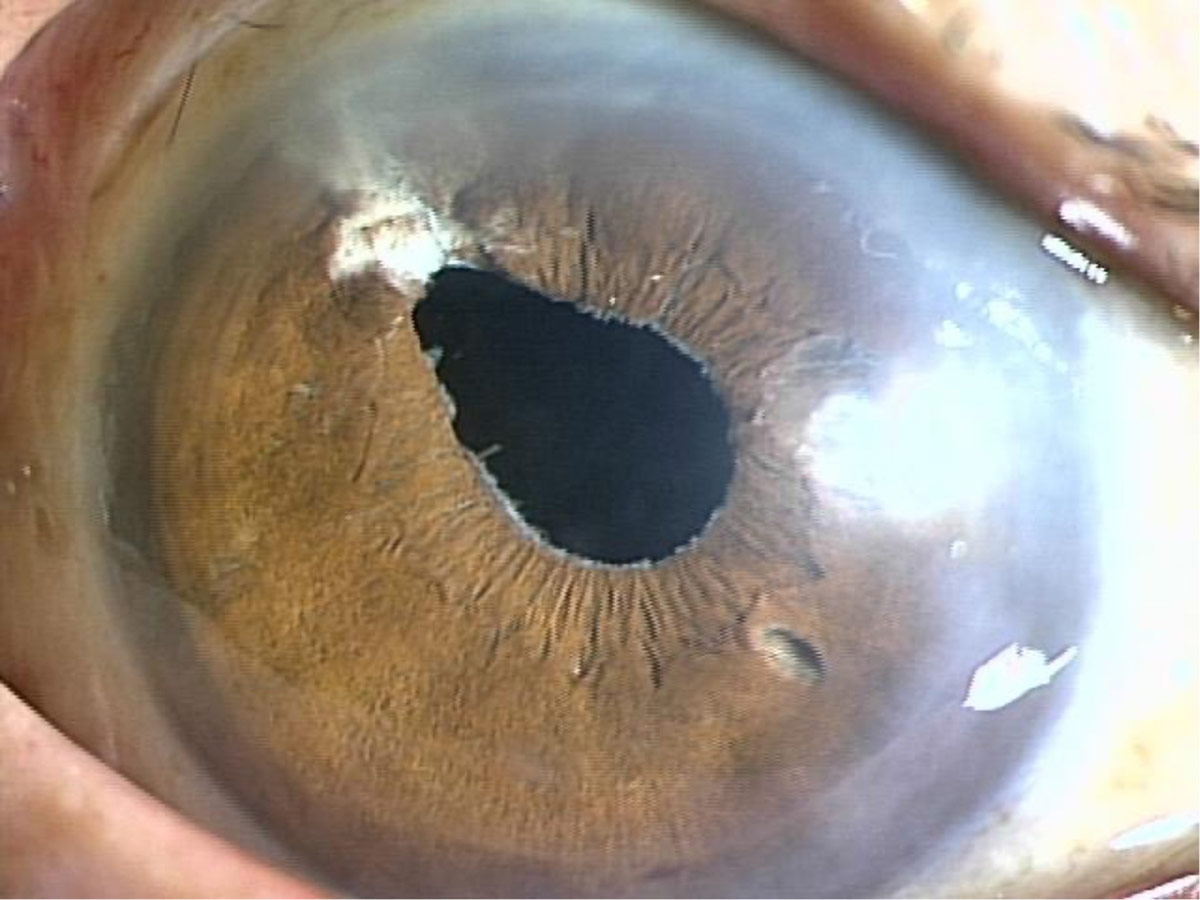 角膜の透明性が向上し、視力も向上している。
