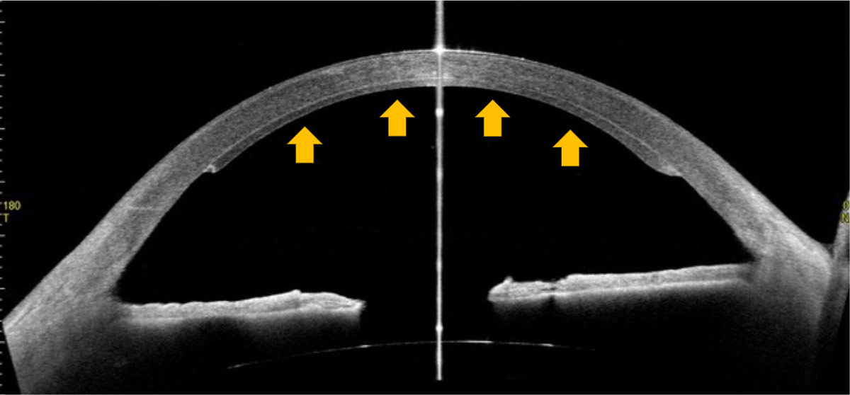 角膜の内側にドナー角膜内皮が接着していることが確認できる。