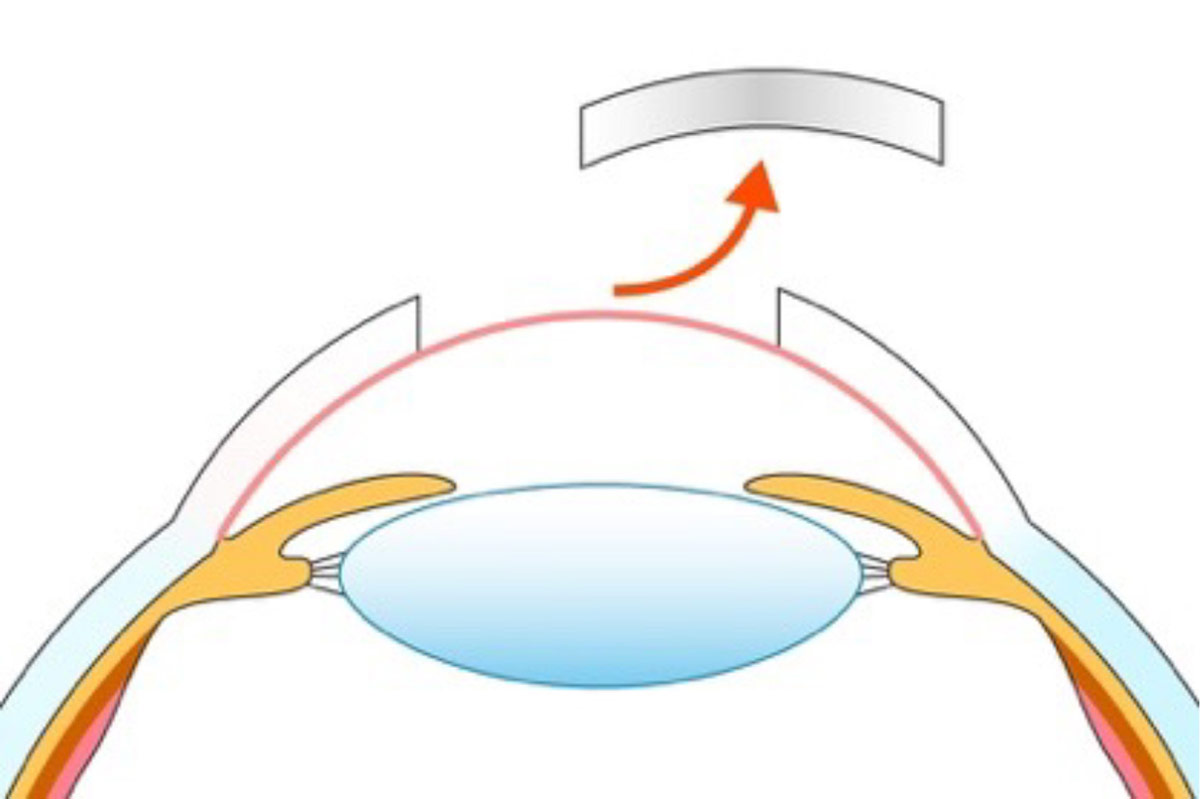 ②角膜の内側にある内皮層は残し、それ以外を円状に切除する