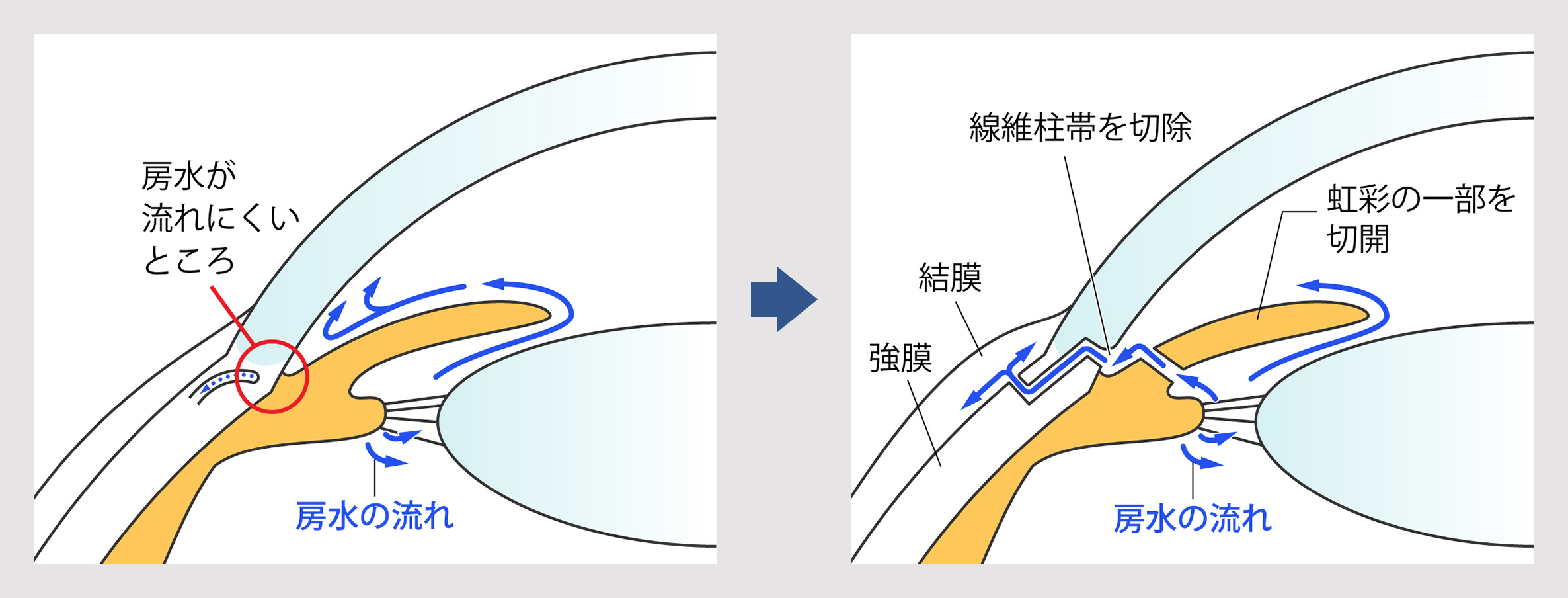 濾過手術