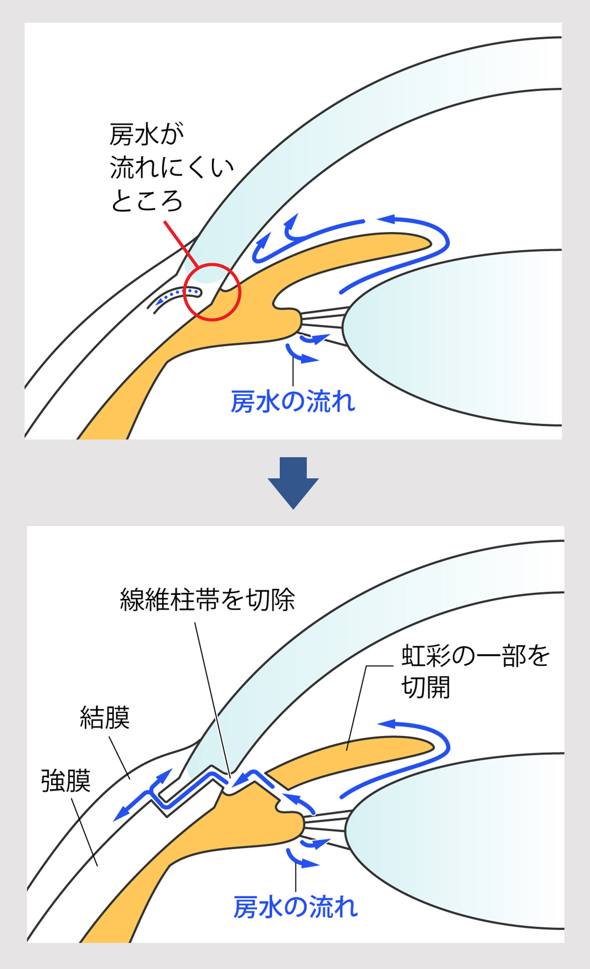 濾過手術