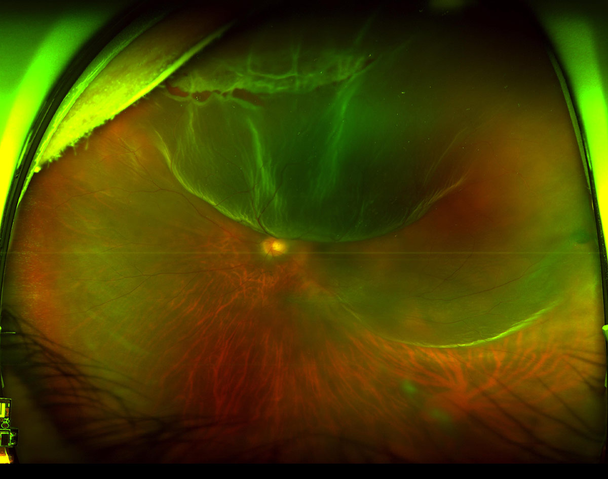 網膜剥離の眼底写真