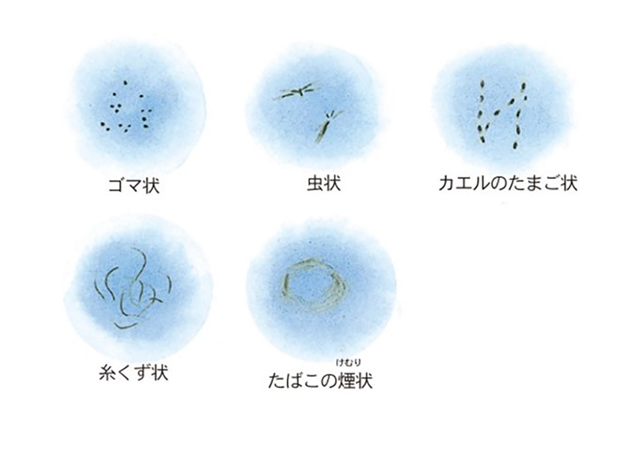 飛蚊症のパターン