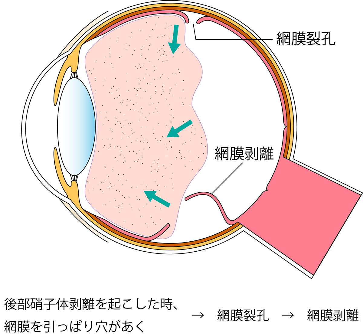 網膜裂孔、網膜剥離のシェーマ