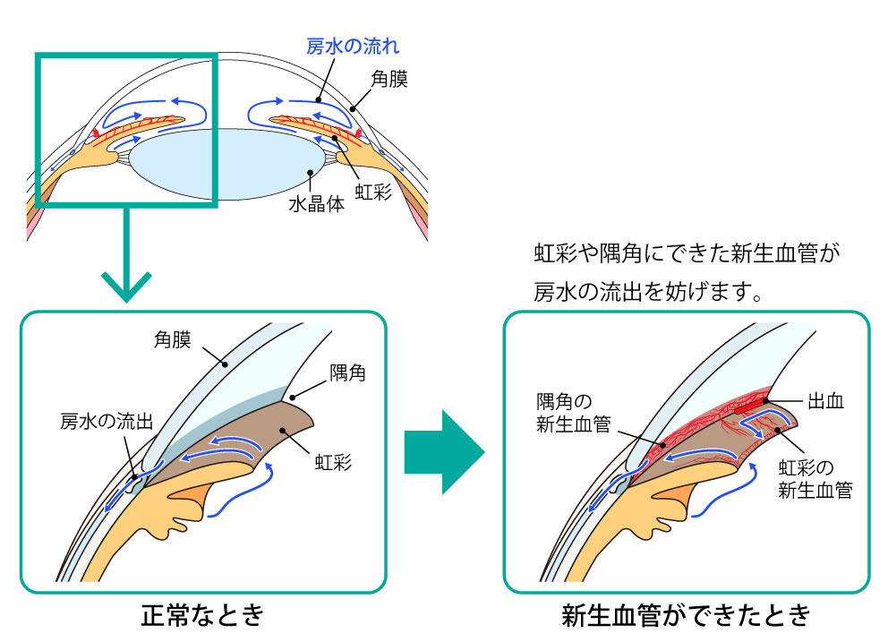 血管新生緑内障のイラスト