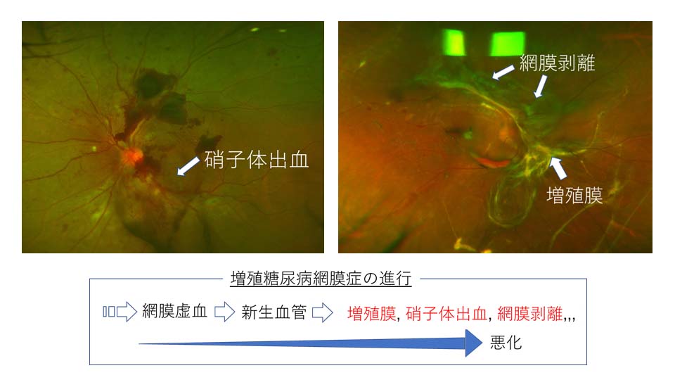 増殖糖尿病網膜症