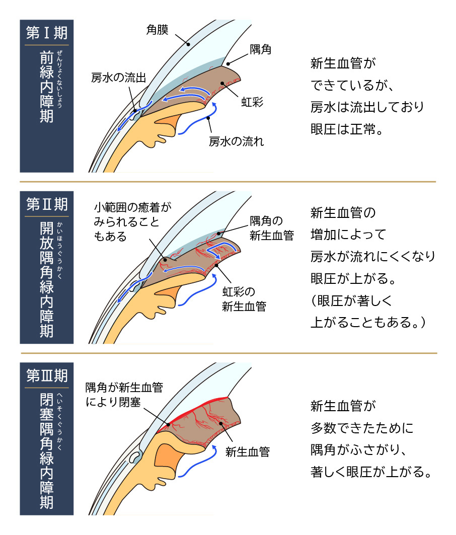 血管新生緑内障の病期