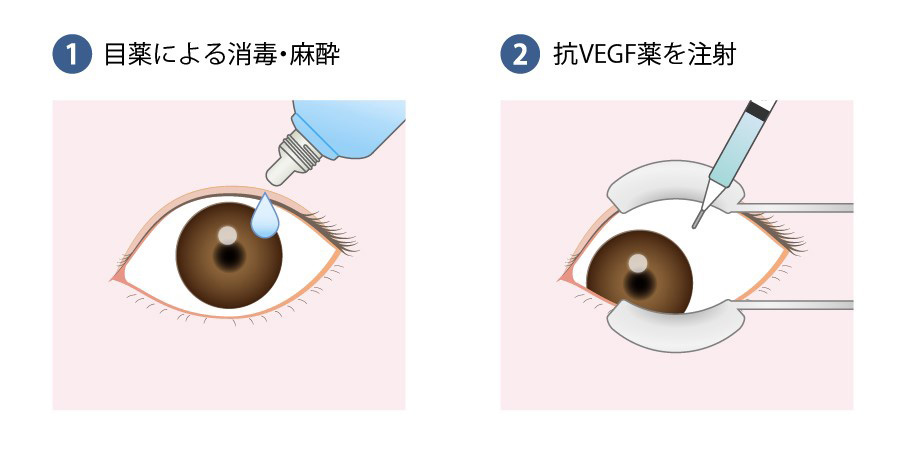 抗VEGF療法