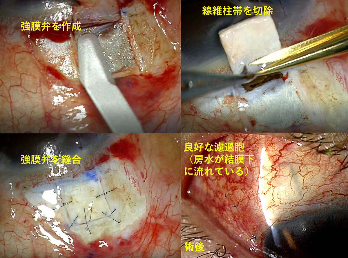 線維柱帯切除術の流れ