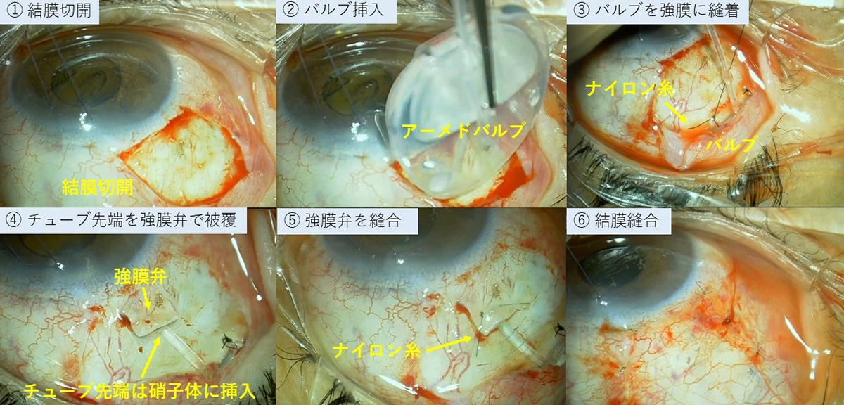 アーメド緑内障バルブの手術手順