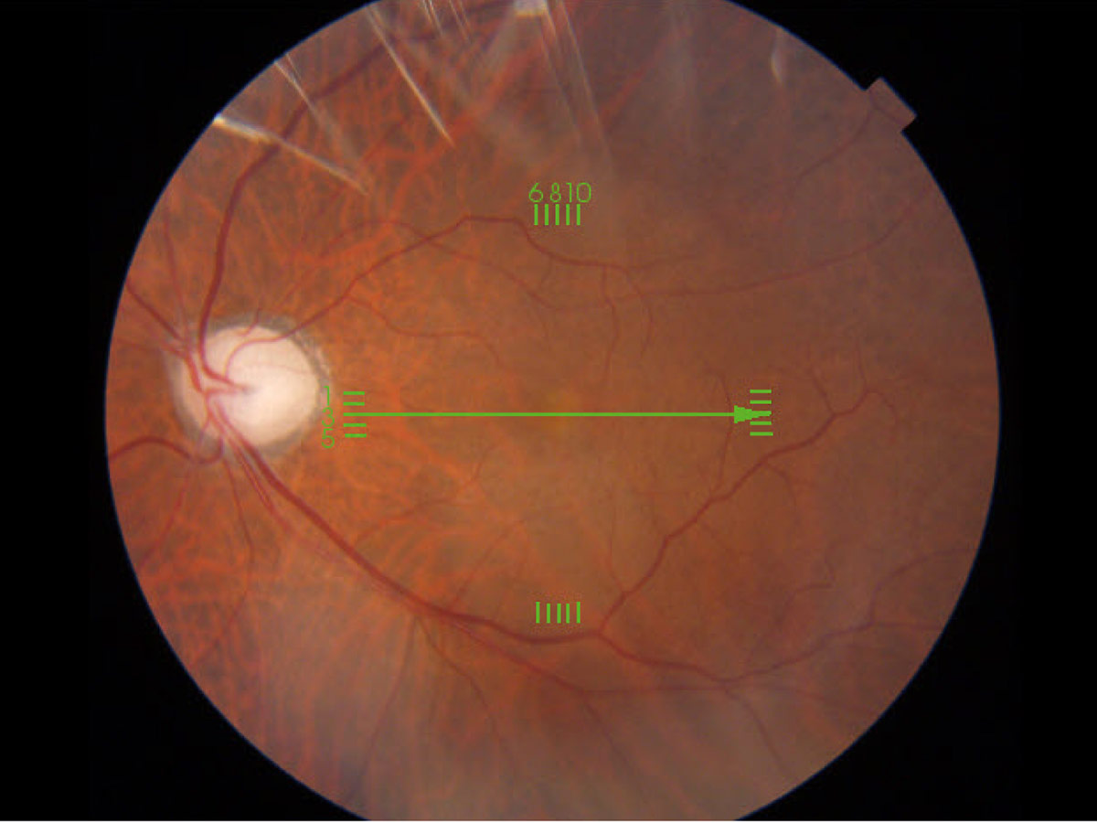 視神経炎や外傷性視神経症の慢性期の視神経萎縮