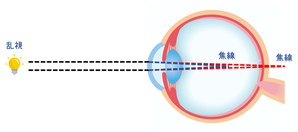 屈折異常（近視・遠視・乱視）｜茨城県水戸市の小沢眼科内科病院
