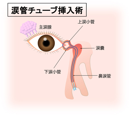 抗がん剤による目の副作用