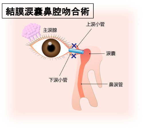 抗がん剤による目の副作用
