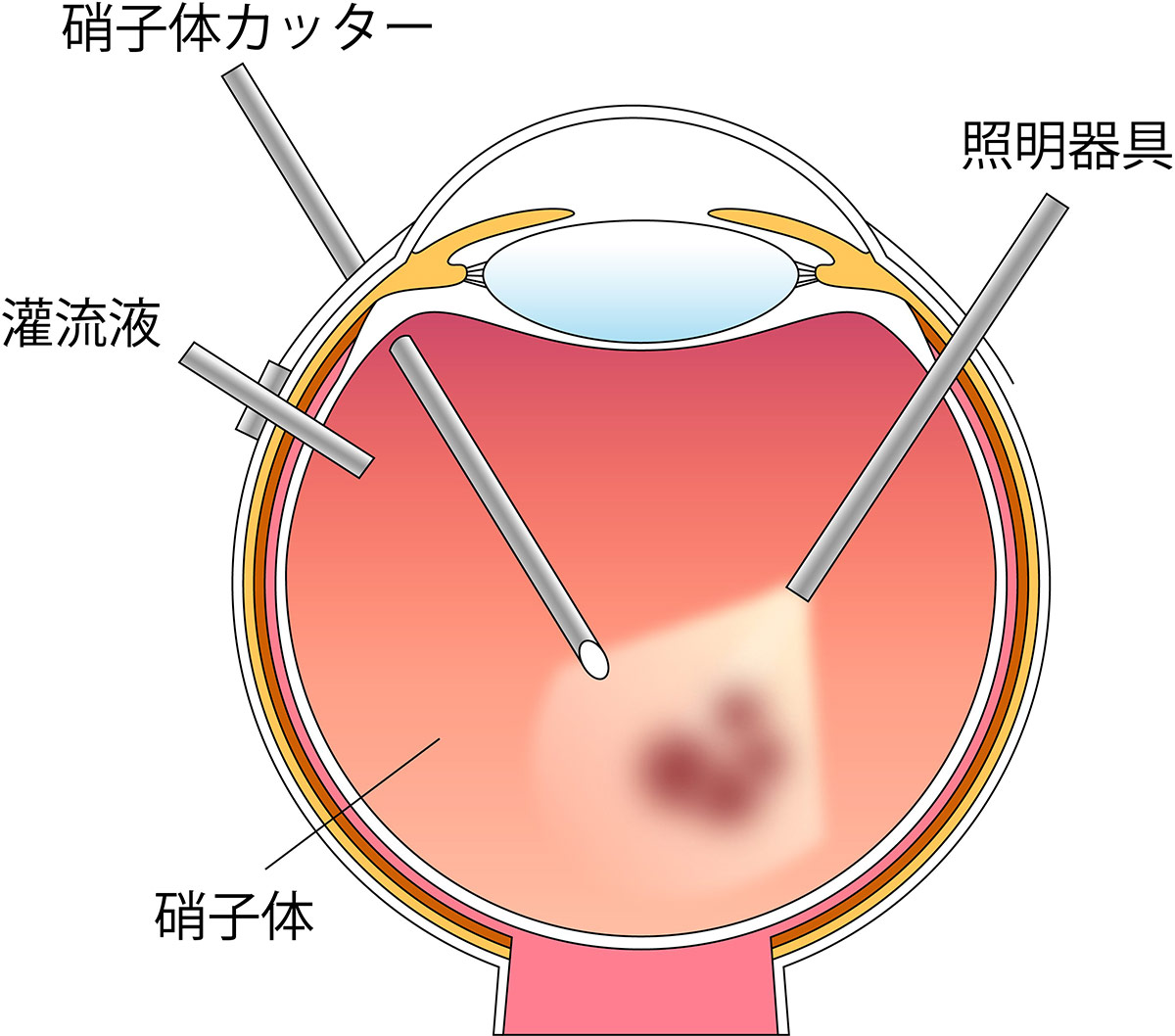 （図5）硝子体手術のイラスト