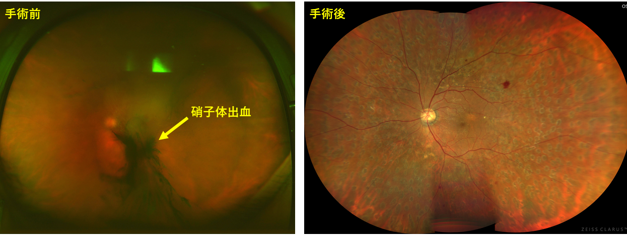 図12 硝子体手術前後の眼底写真