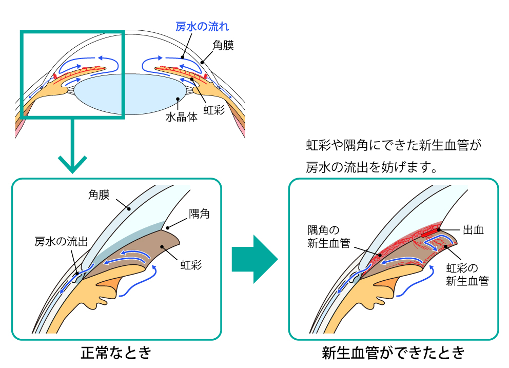 図14 血管新生緑内障のイラスト