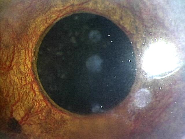 図13 虹彩新生血管