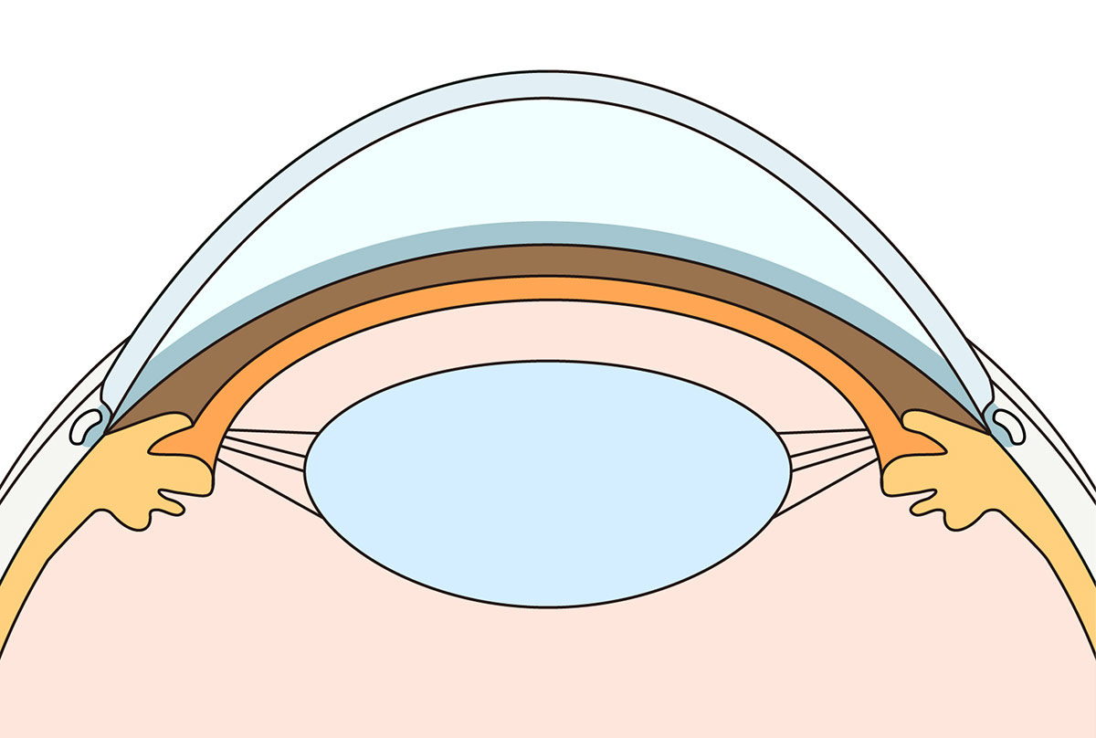 水晶体嚢外固定法