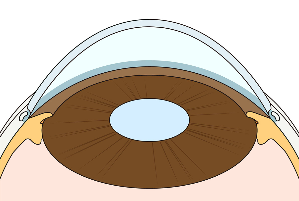 水晶体嚢外固定法