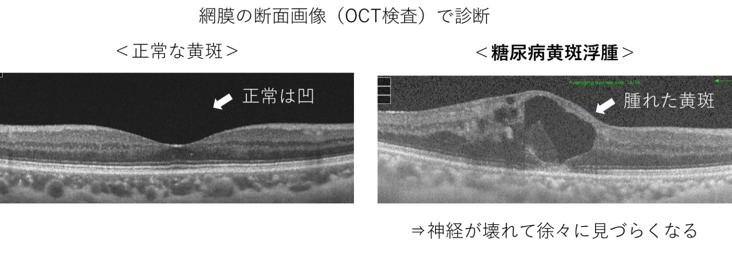 図3　糖尿病黄斑浮腫