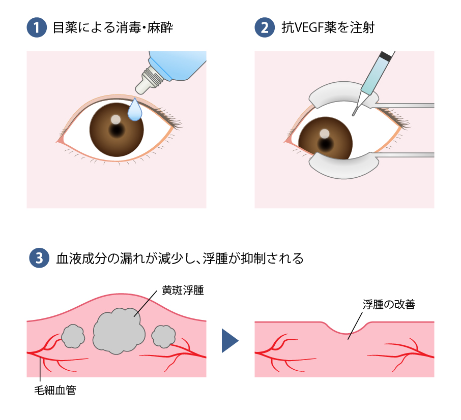 図7 抗VEGF薬硝子体内注射