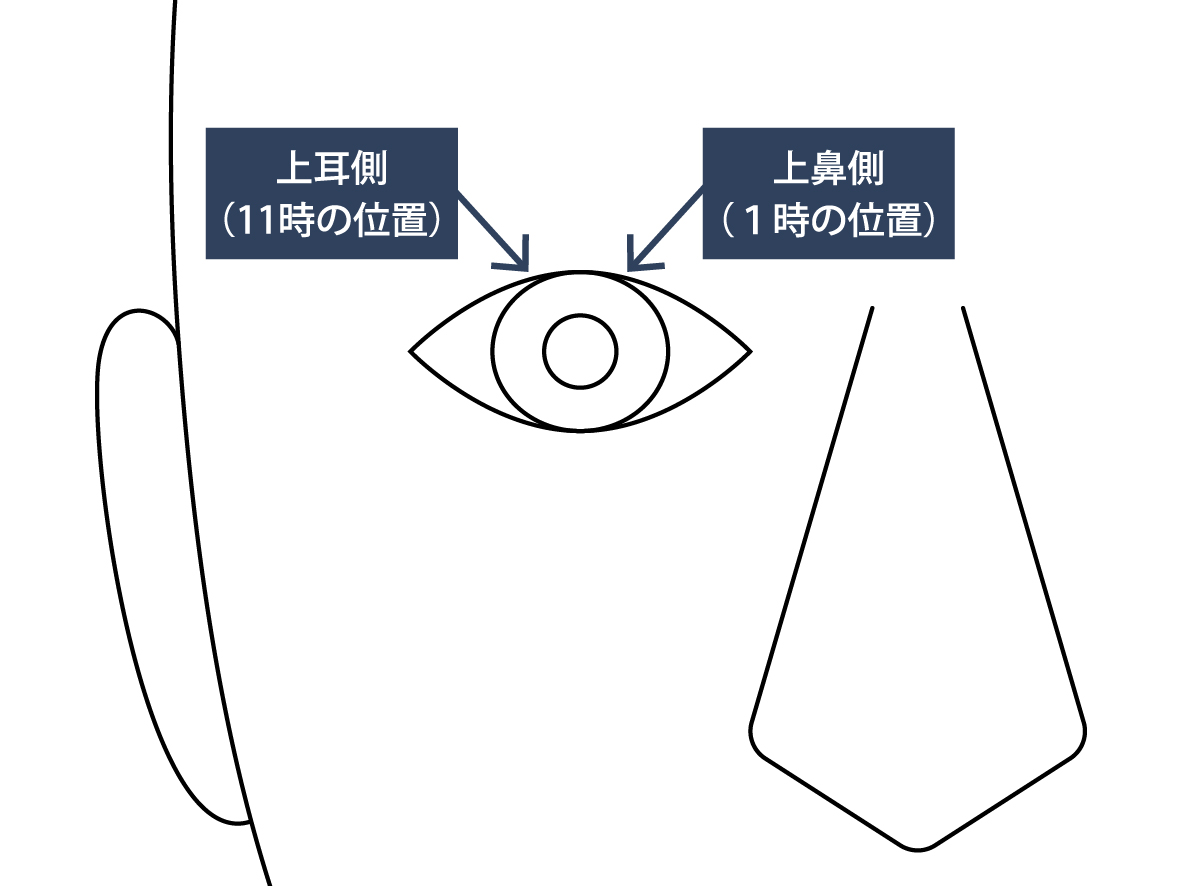 外眼筋を避け、上鼻側もしくは上耳側ののいずれかの位置で実施します