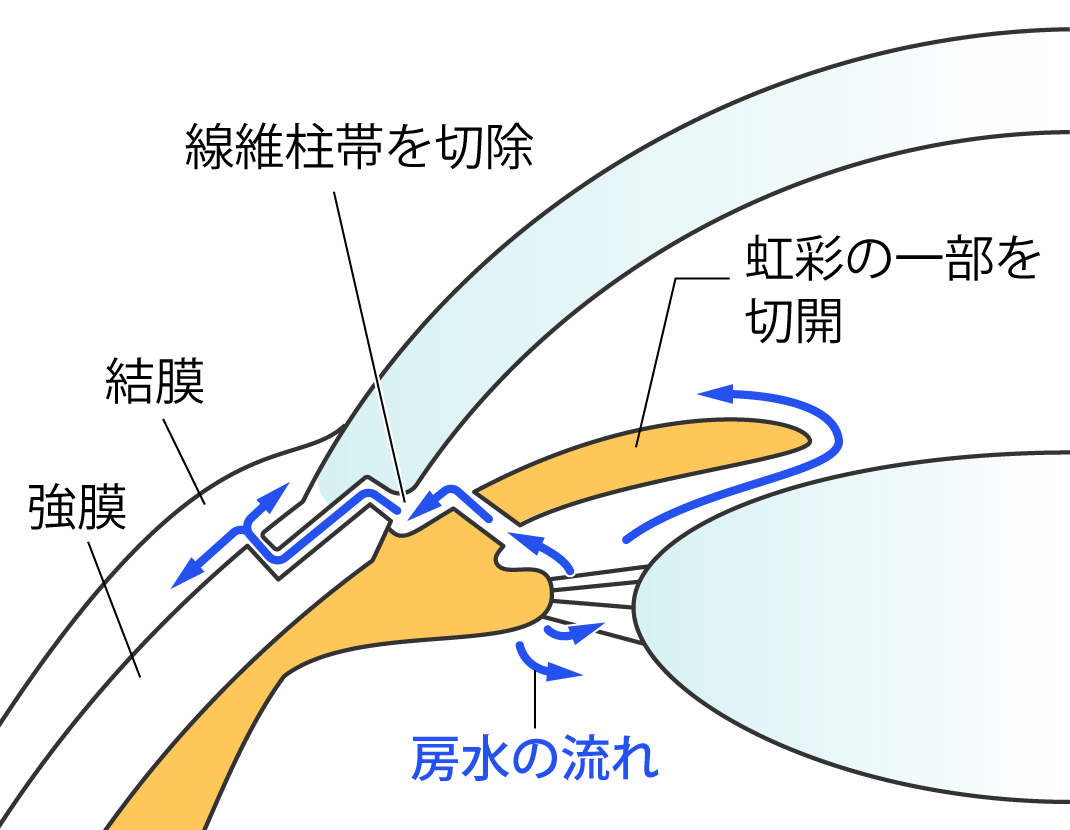 線維柱帯切除術