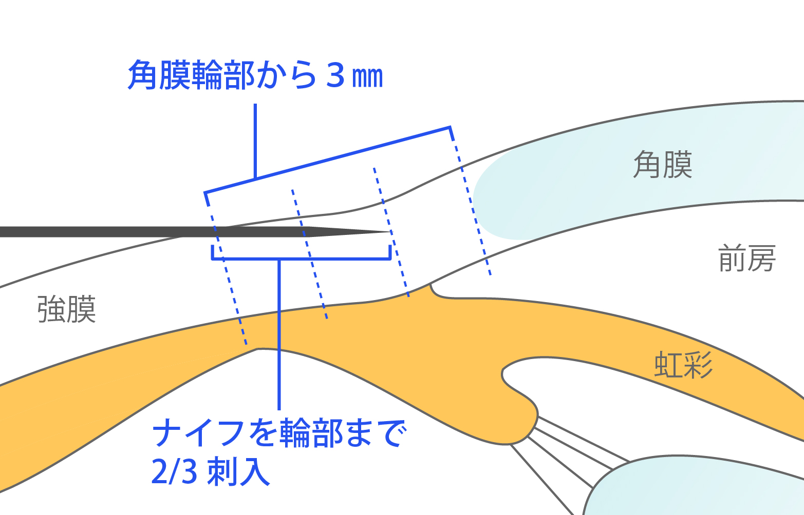 角膜輪部から3㎜の位置に、強膜と平行にナイフが透見できる深さ2㎜進めます