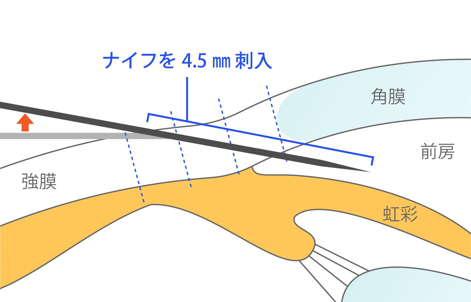 ナイフの先端が虹彩と平行になるように角度を変え、ナイフの先端から4.5㎜まで強膜下に刺入し、フィンを留置する強膜ポケットをします