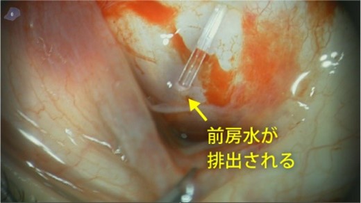 前房からの房水流出を確認します