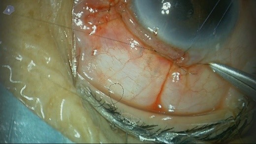 テノン嚢および結膜を輪部付近まで引き出して縫合します