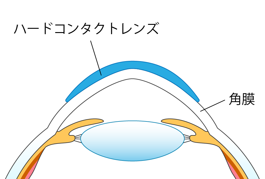 通常のハードレンズは角膜上で装用する