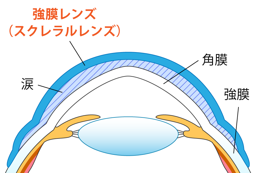 強膜レンズはレンズが大きく、強膜上で装用する